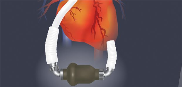 Permanente mechanische Kreislaufunterstützung bei Patienten mit Herzinsuffizienz durch linksventrikuläre Assist-Devices (LVAD).