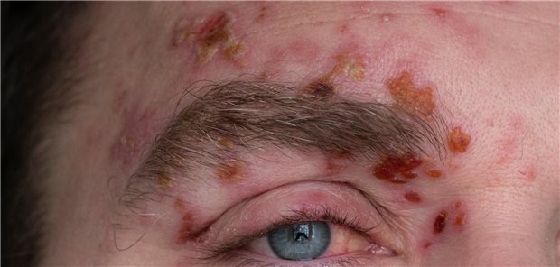 Ausschnitt des Gesicht eines Mannes mit vielen Bläschen eines zoster ophthalmicus um das Auge und auf der Stirn. 