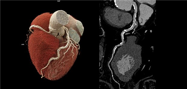 Photon-Counting CT des Herzen eines 87-jährigen Patienten. Trotz sehr schwerer Verkalkungen an den Gefäßwänden (in der 3D-Aufnahme zu sehen), gelingt eine diagnostische Darstellung, die zeigt, dass die Gefäße nicht verstopft sind. Ein Kathetereingriff ist in diesem Fall nicht nötig.