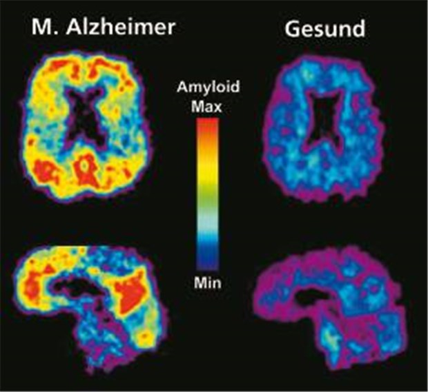 Alzheimer lässt sich immer früher erkennen PiB-PET des Gehirns mit und ohne M. Alzheimer. Typische Amyloidablagerungen (gelb bis rot) werden sichtbar.