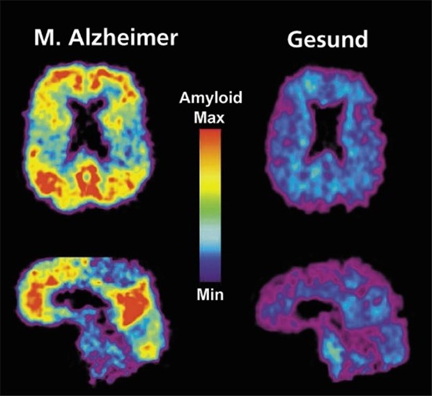 Alzheimer offenbar bei Op übertragbar PiB-PET des Gehirns mit und ohne M. Alzheimer. Typische Amyloidablagerungen (gelb bis rot) werden sichtbar.