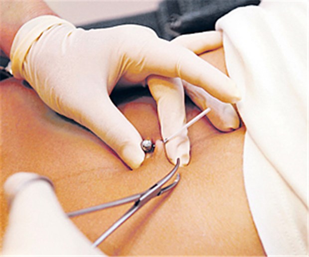 Pfusch bei Piercing & Co.: Wer zahlt? Piercing mit Folgen? Auf der sicheren Seite sind Ärzte, wenn sie die Folgebehandlung zunächst mit dem Patienten privat abrechnen.