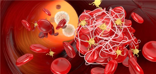 Plättchenhemmer reduzieren die Thromboserate bei hospitalisierten COVID-19-Patienten geringfügig. Das gilt anscheinend auch für nicht-hospitalisierte Patienten mit nur leichter COVID.