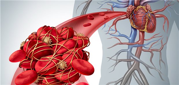 Plättchenhemmung als Schutz fürs Herz nach Stentimplantation.
