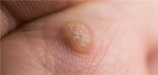 Plantarwarzen lassen sich mit verschiedenen Methoden behandeln. Zuerst kann man es mit Salicylsäure versuchen – klappt das nicht, kommen Laser und Ablation zum Einsatz.