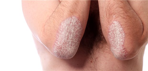 Plaque-Psoriasis: Bei dieser Indikation gibt es eine neue Therapieoption.