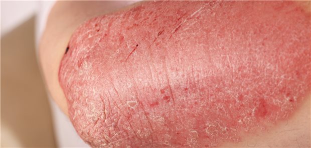 Plaque-Psoriasis: Innerhalb der ersten sechs Monate der Behandlung mit Ustekinumab, Etanercept oder Methotrexat waren schwere Infektionen, die eine Therapie in der Notaufnahme oder einen Krankenhausaufenthalt erforderten, in einer Studie selten.
