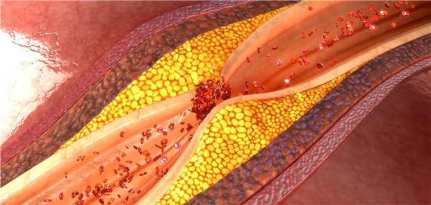 Plaque in der Koronararterie: Mit einem PCSK9-Hemmer zusätzlich zur Statintherapie wurde in einer Studie eine stärkere Plaqueregression erreicht als mit dem Statin alleine.