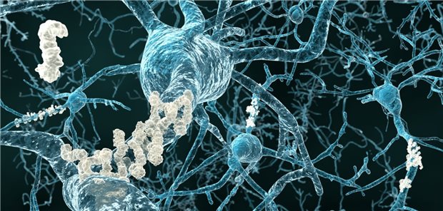 Alzheimer: Lecanemab verbessert in Phase-III-Studie kognitive Beeinträchtigungen Plaques beim M. Alzheimer (Symbol): Schaffen neue Antikörper die therapeutische Wende?