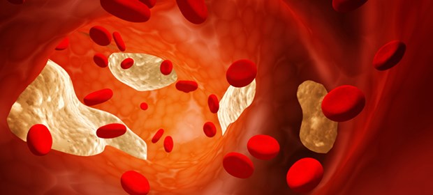 Prävention am besten von Geburt an? Plaques, hüben wie drüben: Cholesterin schon von Geburt an senken?