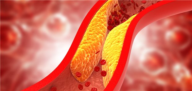 Plaques in den Blutgefäßen: Wer im jungen Erwachsenenalter körperlich fit ist, hat ein geringeres Risiko für Atherosklerose.