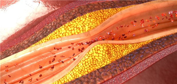 Plaques in der Karotis treten bei Personen mit persistierendem Asthma wohl häufiger auf als bei Personen ohne Asthma.