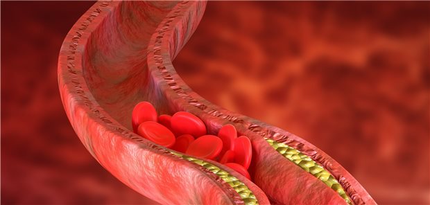 Plaques in einer Arterie: So isoliert, wie es hier scheint, sind sie wohl gar nicht. Da es sich bei Atherosklerose um eine Entzündung der Blutgefäße handelt, reagiert das periphere Nervensystem und sendet Signale ans Gehirn.