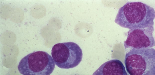 Plasmazellen im Blut eines Myelompatienten.