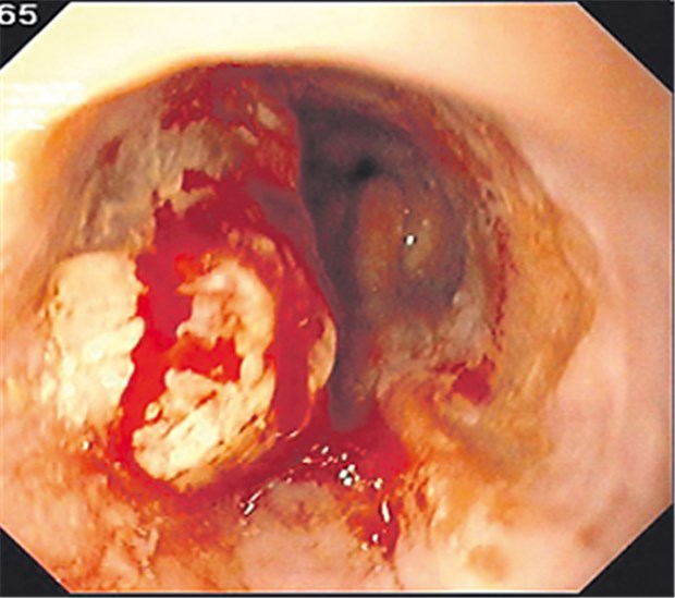 Multimodale Therapiestrategien gelten mittlerweile als Standard Plattenepithel-Karzinom des Ösophagus.