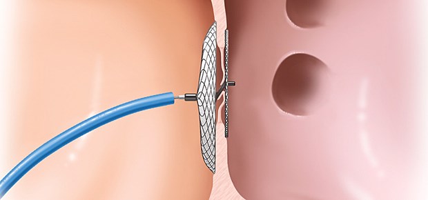 Katheter-Verschluss durchgefallen Platzierung eines per Katheter eingebrachten Occluder-Systems zum Verschluss eines offenen Foramen Ovale.