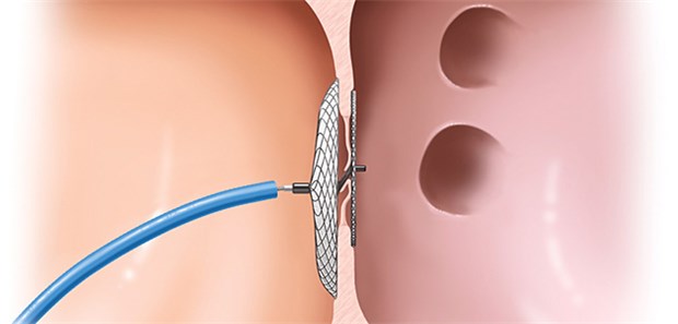 Platzierung eines per Katheter eingebrachten Okkulder-Systems zum Verschluss eines offenen Foramen ovale.