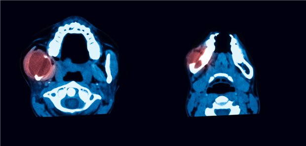 Bilder einer Computertomographie des Kopfes mit einem durch Markierung in rot hervorgehobenen Tumor im linken Unterkiefer. 