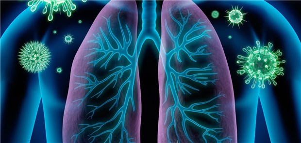 Pneumonie-Gefahr: Infektionen mit Coronaviren führen zu typischen Mustern im CT-Bild.