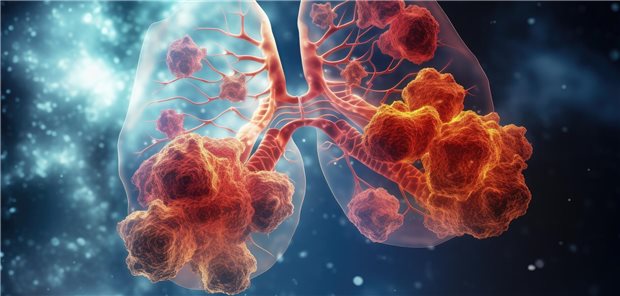 3D-Darstellung einer Lunge mit Pneumonie