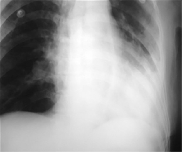 Pneumonie: Höhere Mortalität im Pflegeheim Pneumonie: Sterberisiko im Heim höher.