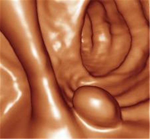 Darmkrebs-Screening mit CT? Polyp im hochauflösenden Dünnschicht-CT.