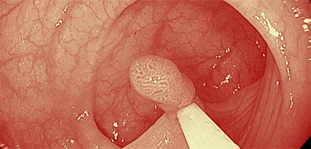 Polypektomie: Das Risiko, innerhalb von zehn Jahren nach der Vorsorge-Koloskopie an Darmkrebs zu erkranken, ist um etwa 90 Prozent niedriger, als bei Personen, die keine Vorsorge-Koloskopie wahrnehmen.