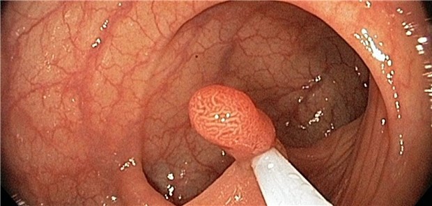 Polypektomie:  Patienten mit Niedrigrisiko-Adenomen und eine Subgruppe mit Intermediärrisiko-Adenomen erkrankten  auch ohne Kontrollen innerhalb von zehn Jahren nicht öfter an Darmkrebsrisiko als die vergleichbare Allgemeinbevölkerung.