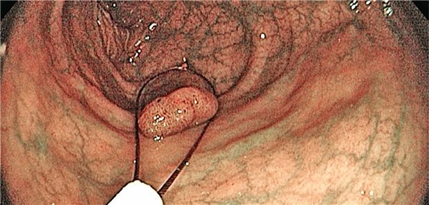 Polypektomie. Was passiert danach im Darm? Forscher haben dazu jetzt Patientendaten analysiert.