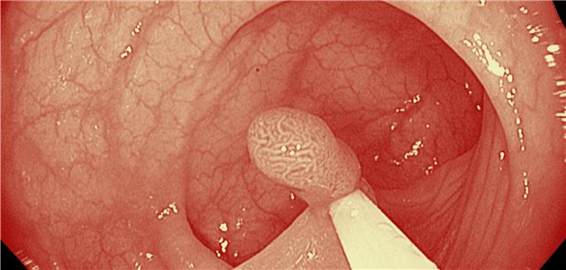 Polypen vollständig zu erwischen, ist wohl gar nicht so einfach. Vor allem ab einer Größe von 10 mm besteht die Gefahr einer inkompletten Resektion.