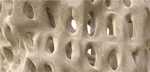 Poröse Knochen (Makroaufnahme). Ein Fall für Calcium – und andere Osteoporose-Therapeutika.