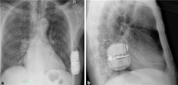 Postoperatives Röntgenbild in 2 Ebenen (a posterior-anterior, b lateral) mit idealer Systemlage und einem PRAETORIAN-Score von 30, Systemimpedanz 58Ω