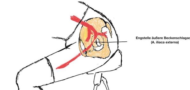 Prädilektionsstelle der iliakalen Endofibrose aufgrund der repetitiven Kompression in aerodynamischer Position.