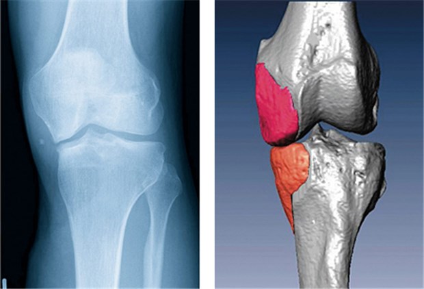 Körpereigener Knochen behebt Knieschaden Präoperatives Röntgenbild (li.) eines Patienten mit ausgeprägten medialen Knochendefekten am distalen Femur und an der proximalen Tibia links nach einem Unfall. Virtuelle Planung der körpereigenen Knochenimplantate (re.).