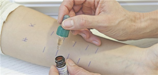 Allergien – Forschung top, Versorgung Flop? Prick-Test auf Allergien: Die Behandlungsmöglichkeiten werden besser, davon profitieren aber nicht alle Patienten.