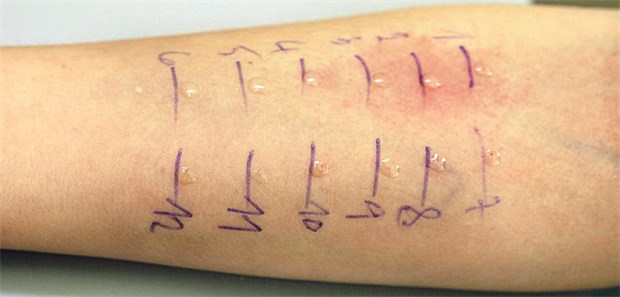 Warum wir einen nationalen Aktionsplan brauchen Prick-Test auf dem Unterarm. Allergiediagnostik wird offenbar zu selten als Leistung abgerechnet.