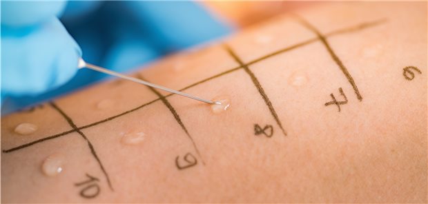 Ruf nach Allergie-Tests für Inhaltsstoffe der Corona-Vakzine Pricktest: Auch die Verträglichkeit der Inhaltsstoffe von Vakzinen ließe sich damit prüfen.