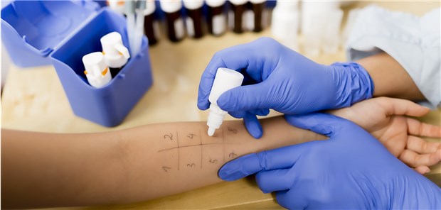 Das sollten Ärzte bei Verdacht auf Arzneimittelallergien tun Pricktest: Die Leitlinie empfiehlt, bei Verdacht auf eine Allergie das Arzneimittel an der Haut zu testen.