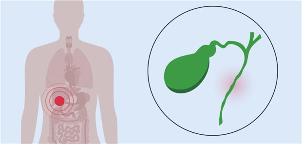 Primärer Endpunkt der Studie war das biochemische Ansprechen, definiert als das Erreichen eines Spiegels der alkalischen Phosphatase (AP) von weniger als dem 1,67-Fachen des oberen Grenzwertes und einem Abfall um 15 Prozent oder mehr vom Ausgangswert, zusammen mit einem normalen Bilirubinwert nach zwölf Monaten. Dieses Ziel erreichten 61,7 Prozent der Seladelpar- und 20,0 Prozent der Placebopatientinnen, ein hochsignifikanter Unterschied zugunsten von Seladelpar.