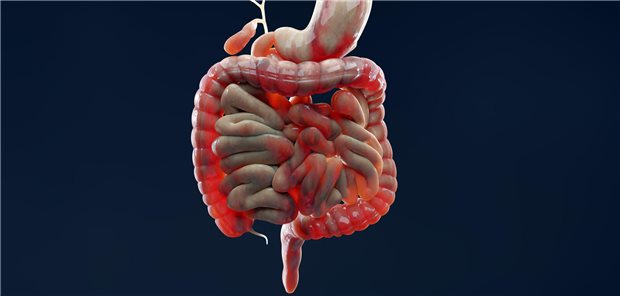 Primäres Ziel der randomisierten Multicenter-Studie PROFILE war eine über 48 Wochen anhaltende Remission, definiert als Symptomfreiheit (HBI kleiner 5) oder fehlende Entzündungszeichen (CRP/Calprotectin nicht mehr erhöht), ohne Steroidtherapie und ohne Operation. Dieses Ziel erreichten mit der Top-down-Therapie 79 Prozent, mit der Step-up-Therapie nur 15 Prozent.