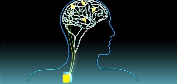 Prinzip der Tiefen Hirnstimulation: Haarfeine Elektroden werden in einen bestimmten Bereich des Gehirns geschoben. Über ein dünnes Kabel sind sie mit einer Batterie im Brustraum verbunden. Durch elektrische Impulse können Aktivitäten der Hirnregion verändert werden. 