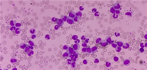 Prof. Dr. Andreas Hochhaus vom Universitätsklinikum Jena resümierte, dass Asciminib die Optionen für die Erstlinientherapie der chronischer myeloischer Leukämie (CML) in der chronischen Phase erweitern und verbessern könnte.
