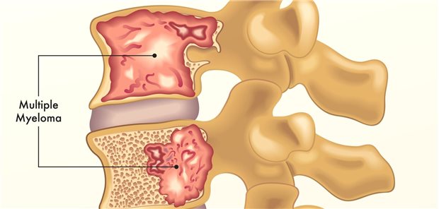 Prof. Dr. Meletios Dimopoulos von University of Athens School of Medicine resümierte, dass zusammen mit den Ergebnissen aus DREAMM-7 die Daten aus DREAMM-8 nahelegen, dass eine Therapiekombinationen mit dem Antikörper-Wirkstoff-Konjugat (ADC) Belantamab-Mafodotin ein neuer Standard für Patienten und Patientinnen mit einem rezidivierten/refraktärem Myelom ab dem ersten Rezidiv sei. 
