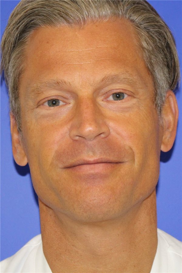 Vor Tonsillektomie Historie beachten Prof. Jochen Windfuhr ist Chefarzt der HNO-Klinik Mönchengladbach und Mitautor der Studie „Halsschmerzen als Operationsindikation vor und nach Publikation der Tonsillitis-Leitlinie“