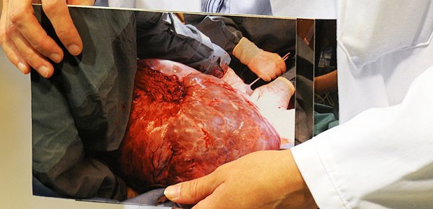 Riesen-Tumor aus Bauch einer Rentnerin entfernt Professor Pauline Wimberger, Direktorin der Klinik für Frauenheilkunde und Geburtshilfe der Uniklinik Dresden, zeigt ein Foto des herausgeschnittenen 28 Kilogramm schweren Tumors.