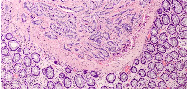 Professorin Irene Esposito und Kollegen resümieren, dass die korrekte Einordnung der neuroendokrinen Neoplasien (NEN) mit der Bestimmung des Subtyps, der Proliferationsaktivität und des Tumorstadiums für das weitere therapeutische Prozedere eine wesentliche Rolle spielt.