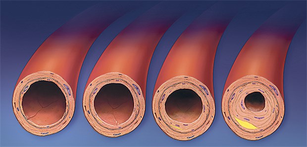 Atherosklerose entsteht wohl anders als gedacht Progression der Atherosklerose – hier sehr vereinfacht dargestellt.
