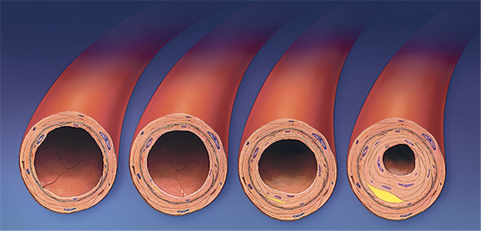 Atherosklerose entsteht wohl anders als gedacht