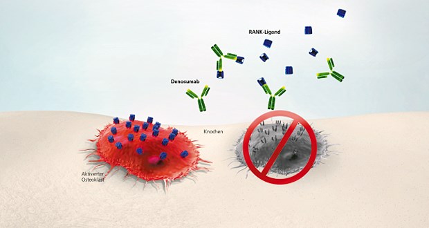Prolia® (Denosumab) hemmt die Knochenresorption durch gezielte Hemmung der Osteoklastogenese: Inhibiert wird speziell der RANK-Ligand, ein primärer Mediator der Osteoklastenaktivität.