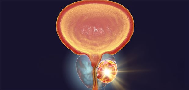 Schematische Darstellung eines Prostata-Ca: Forscher tüfteln auch hier an neuen diagnostischen Optionen.